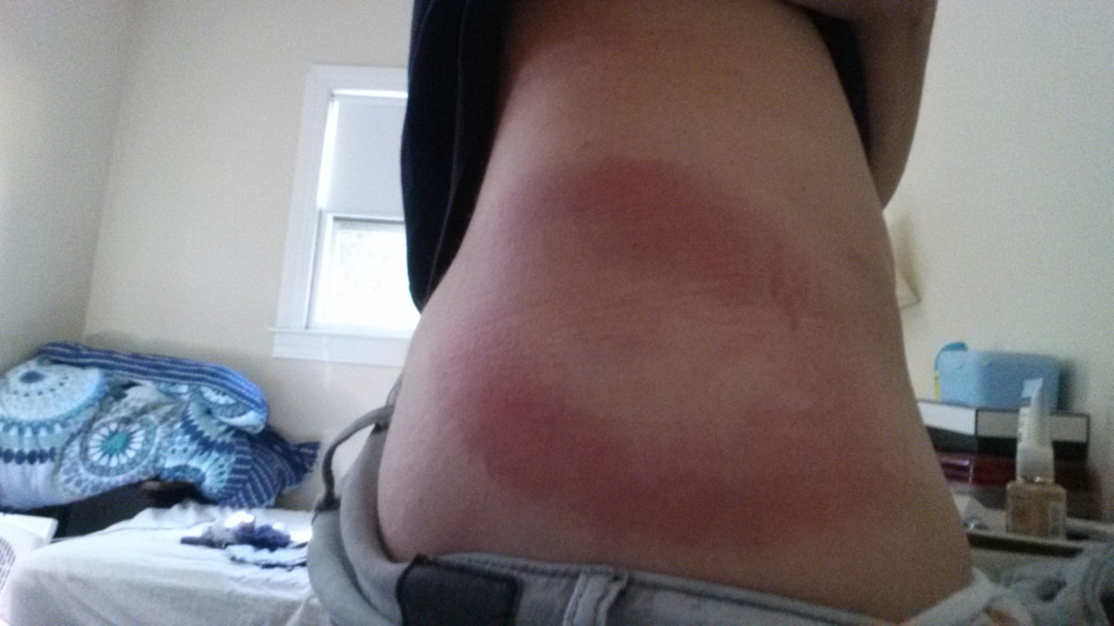 lyme disease red bullseye rash